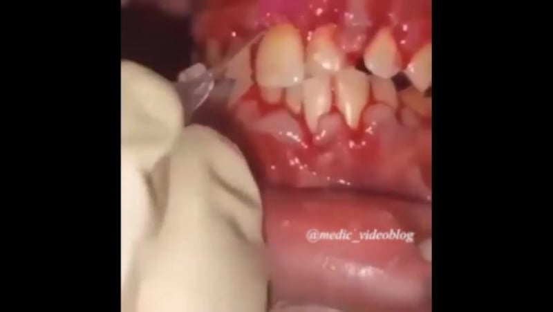 Запущенная полость рта