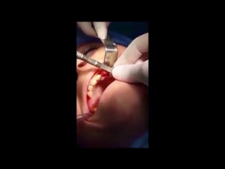 Работа с имплантатами tag dental