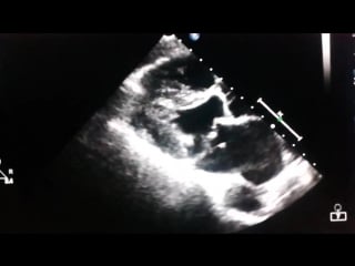 Mitral valve prolapse