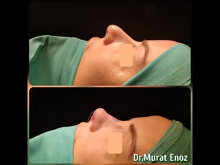 Micromotor assisted natural female rhinoplasty