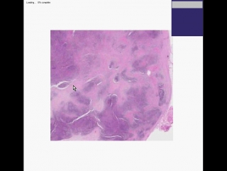 Lymph node nodular sclerosis hodgkin lymphoma