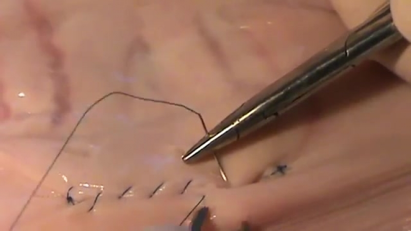 Кишечный шов ламбера docent a d stepanov, пдату