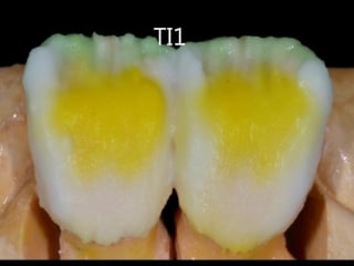 Stratification stage denis rizzo(emax céramique)