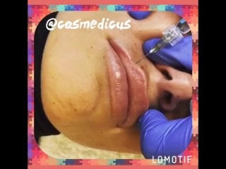 Увеличение губ филлером juviderm 💉👄 врач косметолог ася геворгян ☝🏻️