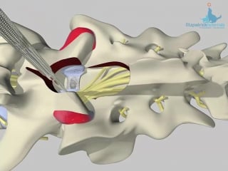Dorsal view of lumbosacral distraction stabilisation surgical technique
