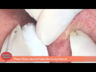 Выдавливание угрей