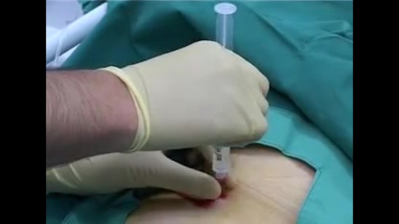 Использование катетера фолея