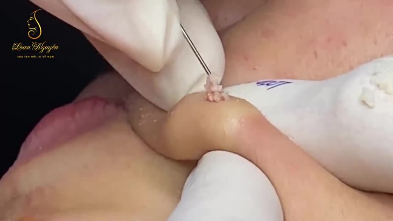 Выдавливание большой кисты на щеке