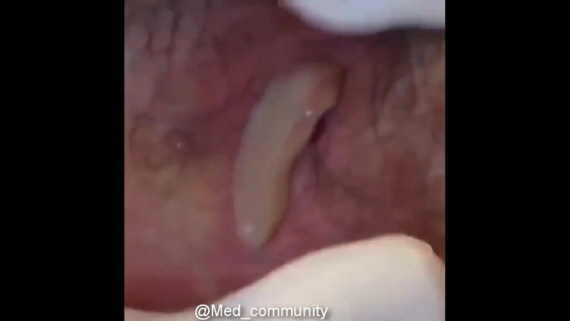 Гидраденит гнойное воспаление потовых желез