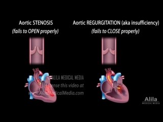 34 aortic valve disease ★ animation