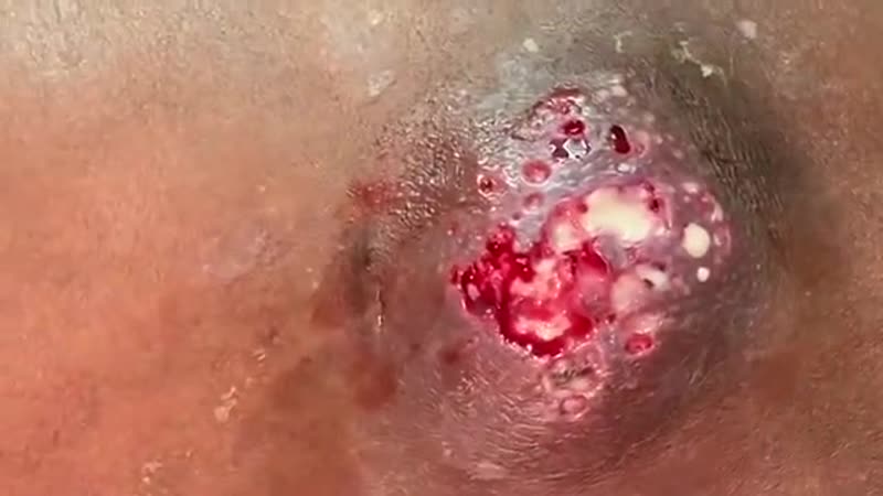 Огромный карбункул на спине выдавливание и последующая перевязка