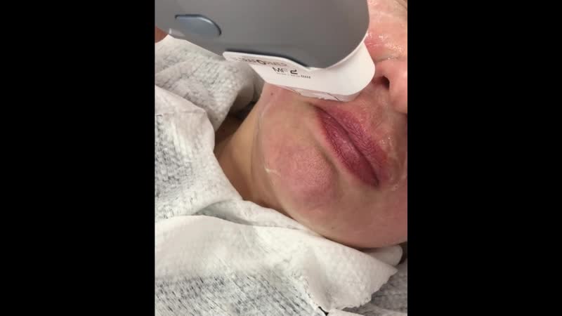 Смас лифтинг