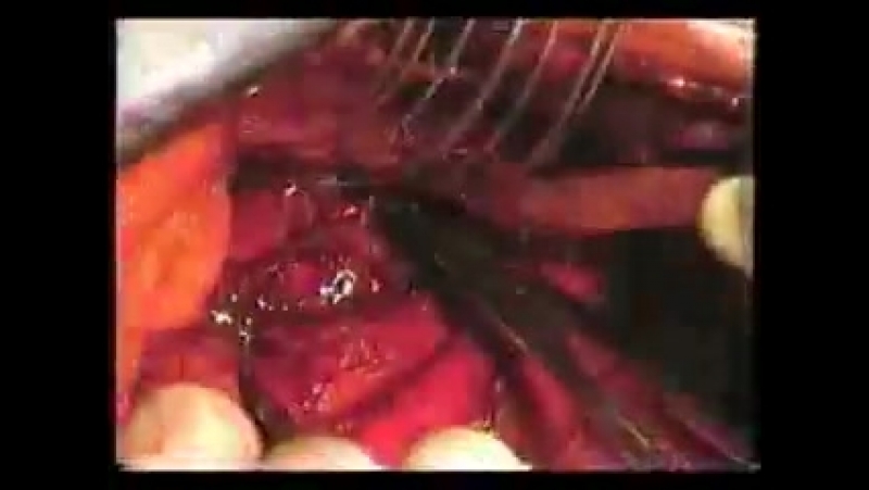 Резекция бифуркации трахеи и части легкого