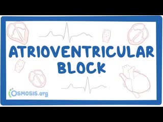 Atrioventricular (av) block first, second, third complete degree