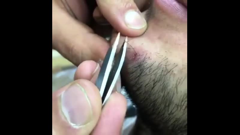 Вросший волос