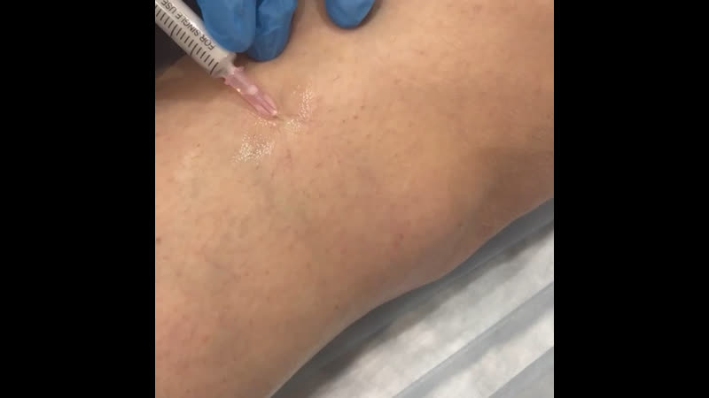 Склеротерапия, сосудистый центр «флебоэксперт»