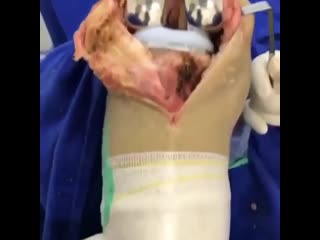 Эндопротезирование коленного сустава