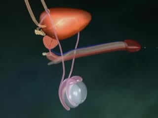 3d моделированние мужской стерилизации