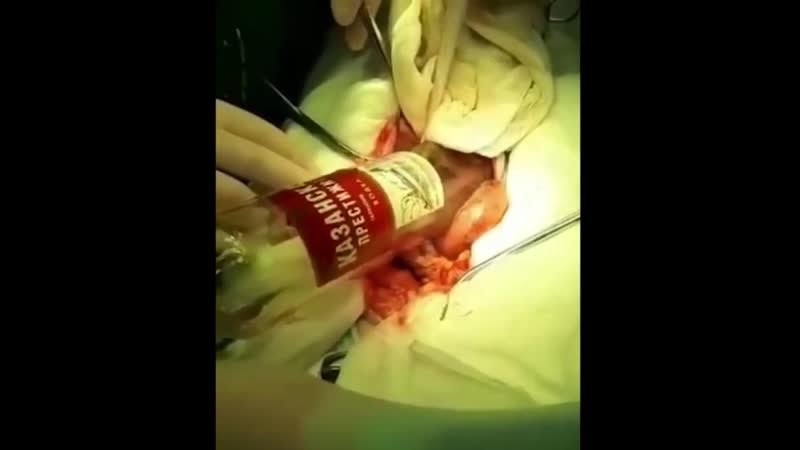 Мужчина засунул в анальное отверстие стеклянную литровую бутылку, а вытащить обратно уже не смог удивлены были даже медики