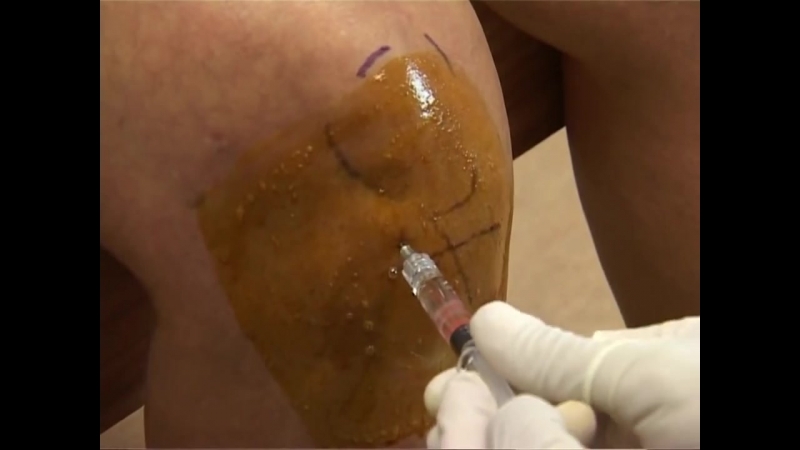 Инъекция в коленный сустав переднелатеральный доступ