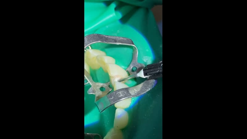 Глубокий кариес стоматология