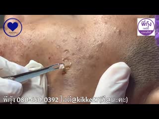 Чистка лица косметической петлей