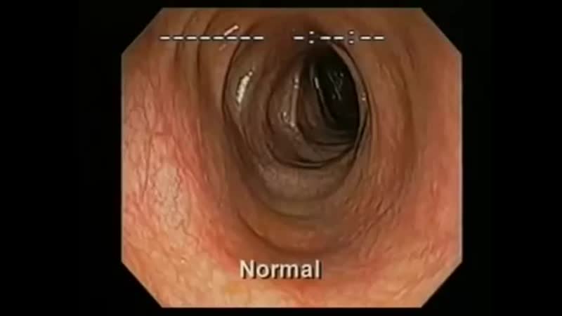 Колоноскопия кишечника