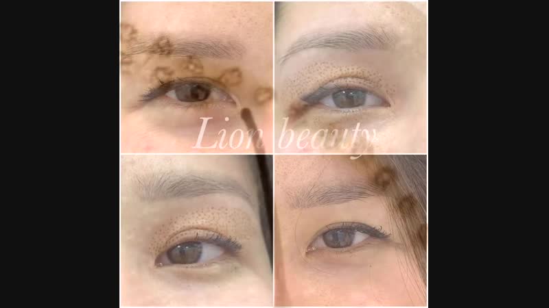 Plasma lift безоперационная блефаропластика