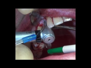 Straumann dental implant surgery step by step part 1