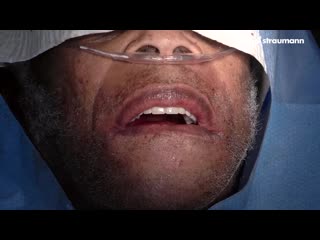 Edmond bedrossian immediate double arch restoration with straumann® pro arch blx