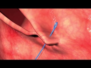 V loc wound closure reloadfor use with endo stitch and sils stitch animation