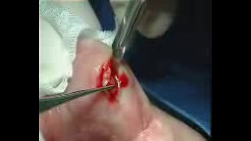 Биопсия губы (английский)