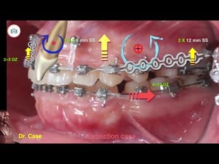 Gummy smile aao 2019 part 1 ортодонтия