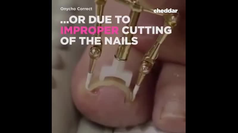 Как вам новые методы лечения вросшего ногтя?