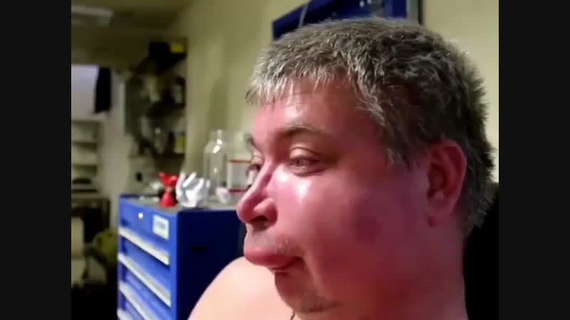 Когда укусила оса