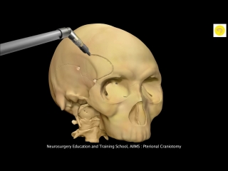 Neurosurgery 3d animation video pterional craniotomy