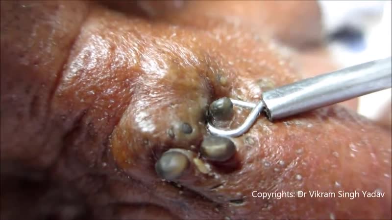 Огромные черные точки на носу