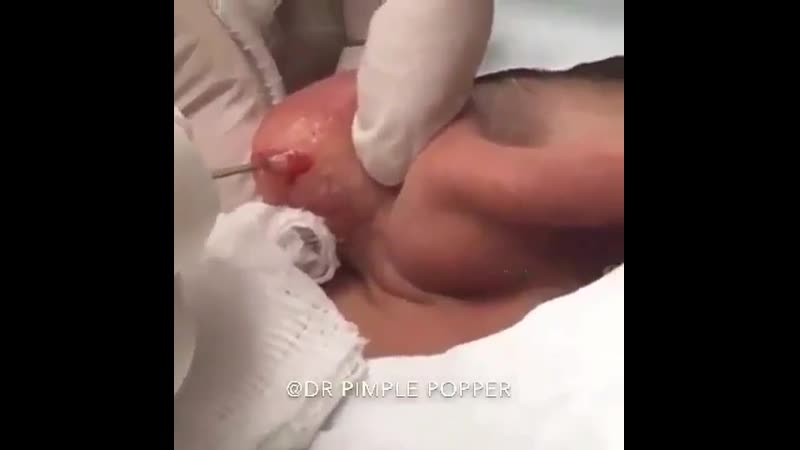 Воспалительный процесс слизистой оболочки среднего уха