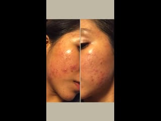 Mi problema de acné / my acne problem