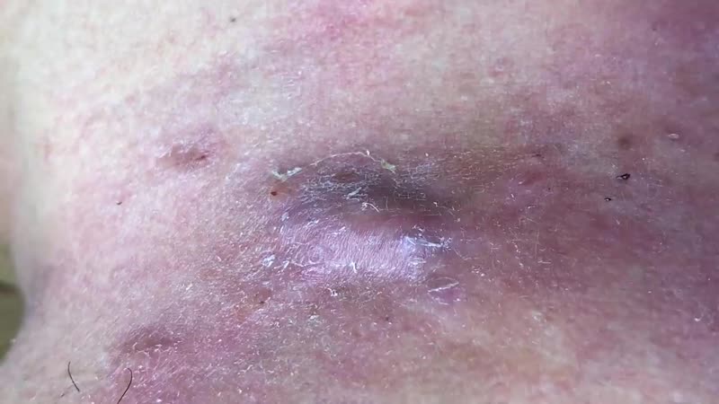 Большое воспаление на шее