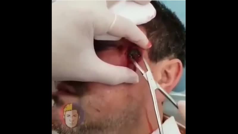 Пулевое ранение ( травмат) 🔫