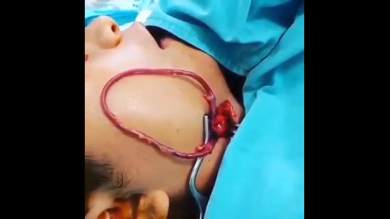 Перенесение подкожной вены на лицевые сосуды