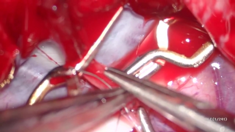 28 наложение экстра интракраниального микрососудистого анастомоза при болезни моя моя