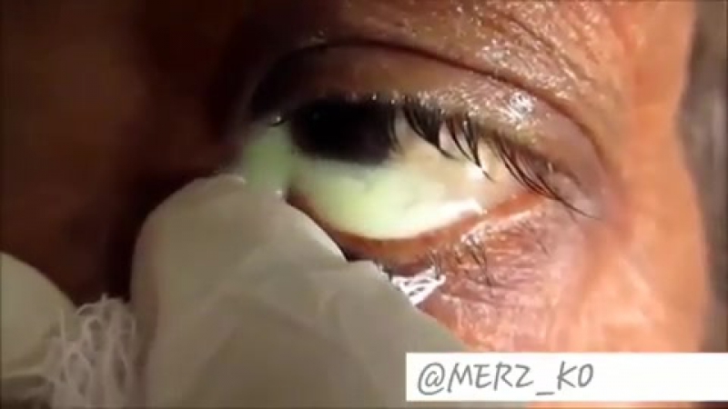 Глазная инфекция