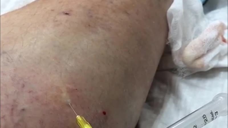 Склеротерапия в процессе