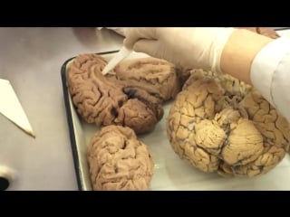 16 базальные ядра и боковые желудочки большого мозга