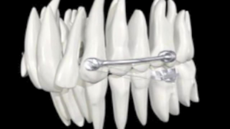 Carriere distalizer biomechanics animation ортодонтия