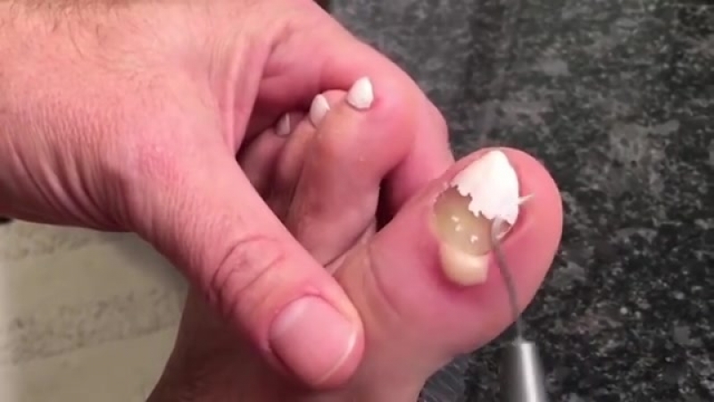 Скопление гноя под ногтем