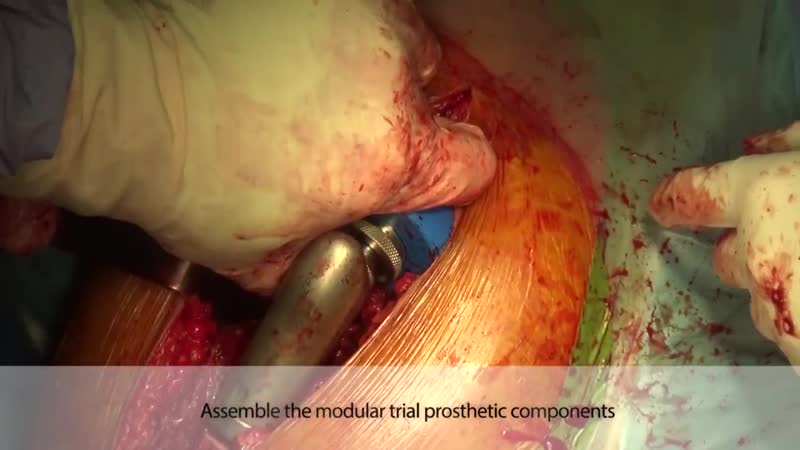 Proximal femur resection and replacement