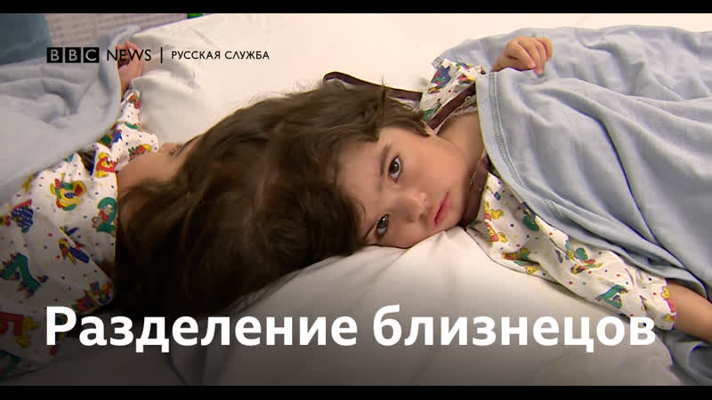 Разделение сиамских близнецов уникальная операция британских врачей